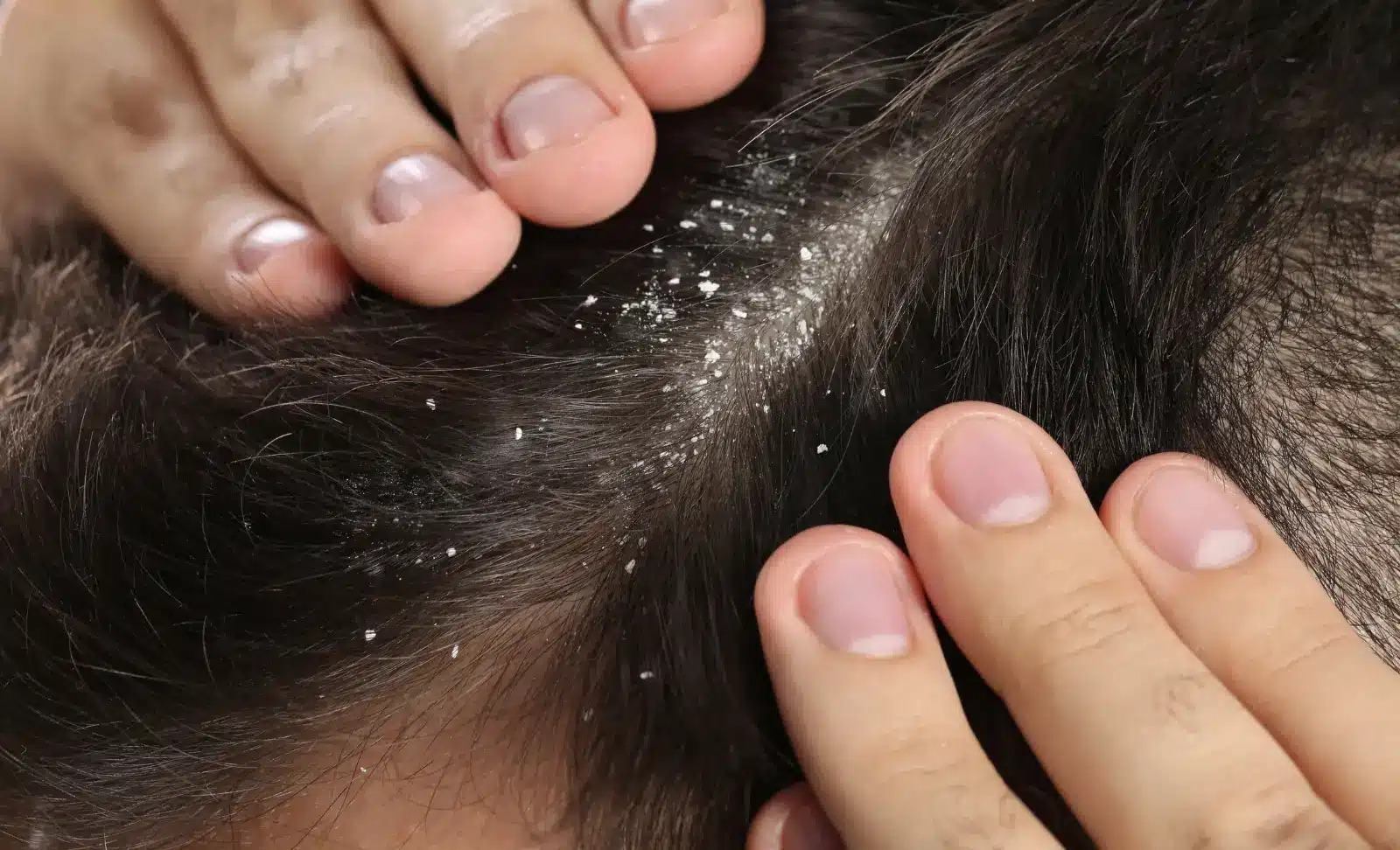 Dandruff